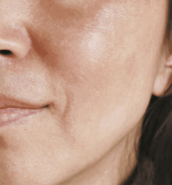 After Acne & Pigmentation Treatment treatment