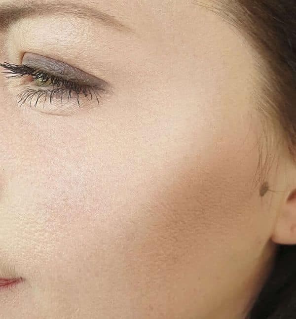 After Fine Lines & Wrinkles treatment