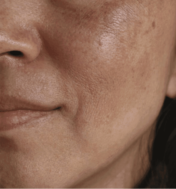 Before Acne & Pigmentation Treatment treatment