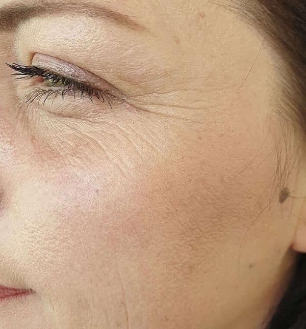 Before Fine Lines & Wrinkles treatment