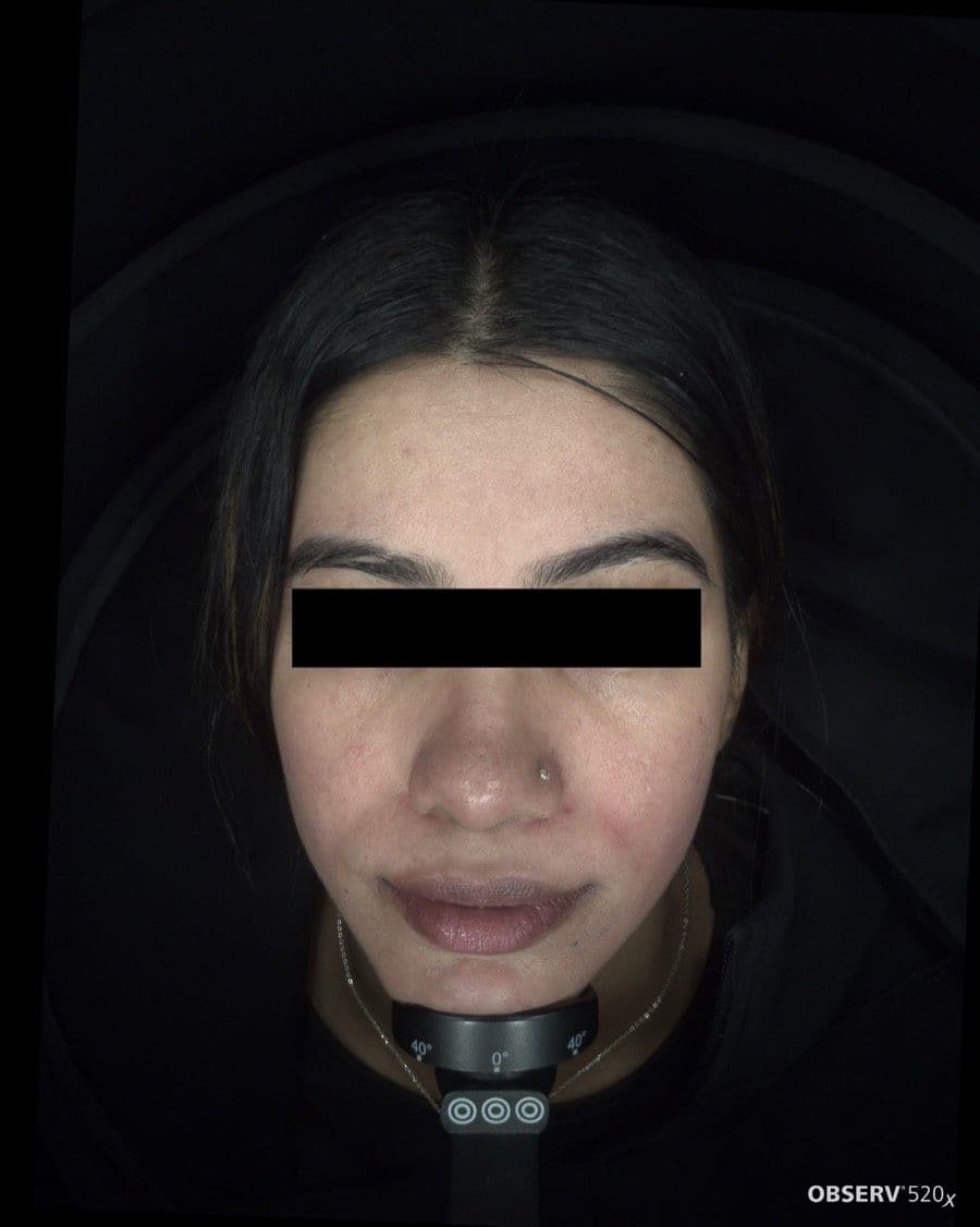 After Acne & Pigmentation Treatment treatment
