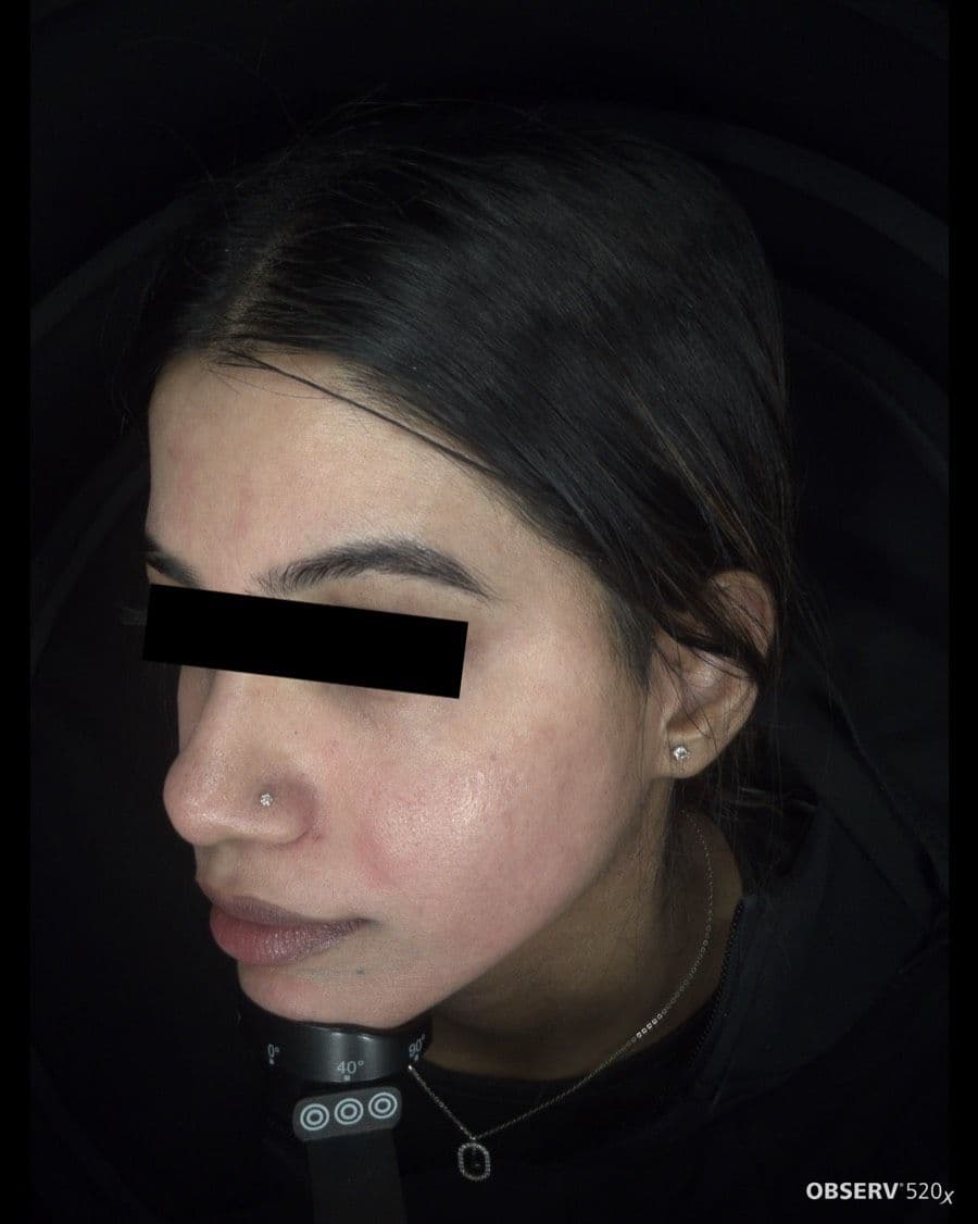 After Acne & Pigmentation Treatment treatment