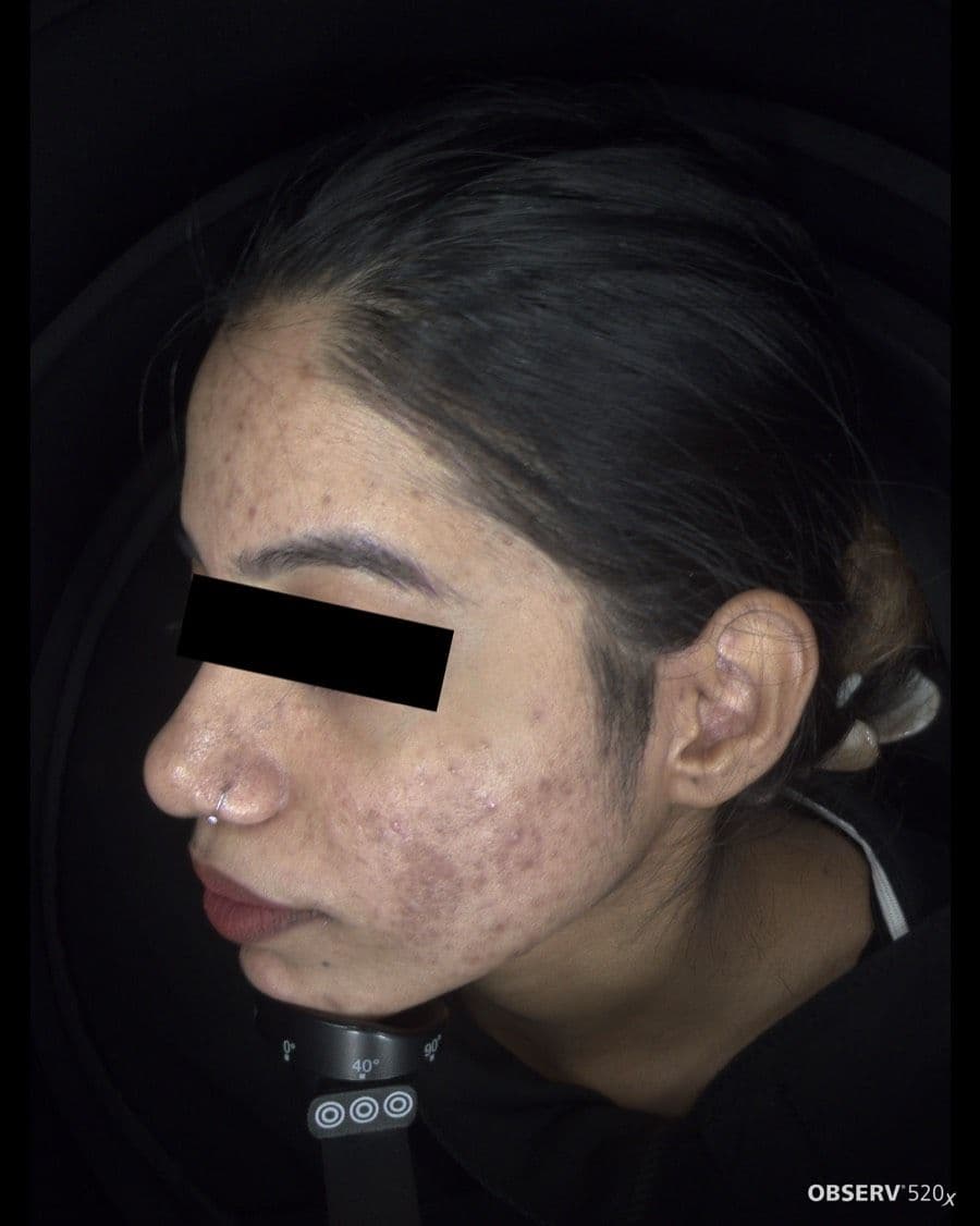 Before Acne & Pigmentation Treatment treatment