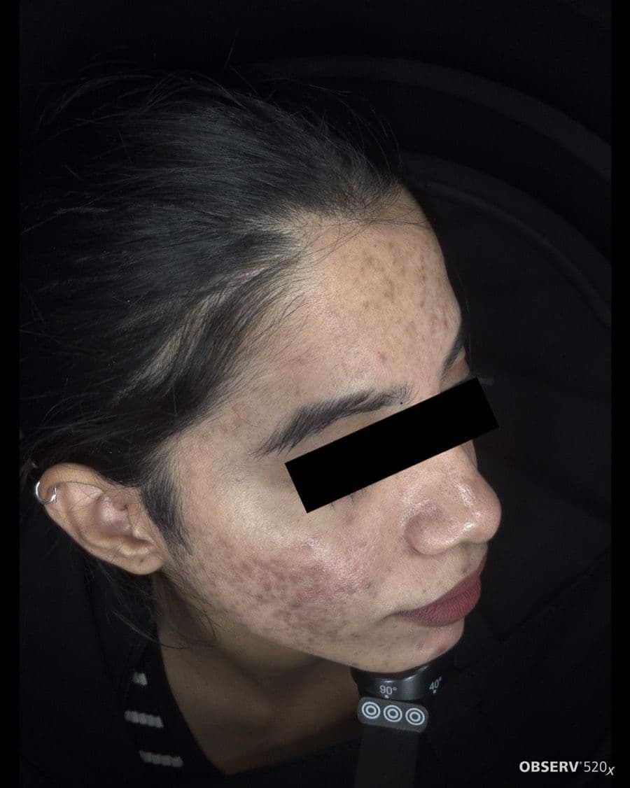 Before Acne & Pigmentation Treatment treatment