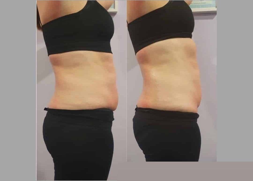 Fat Reduction before and after results