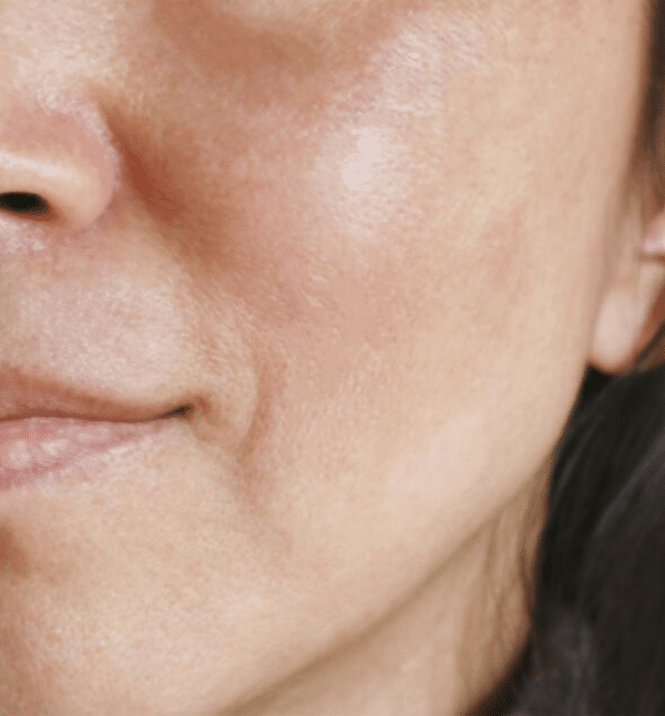 Acne & Pigmentation Treatment — After