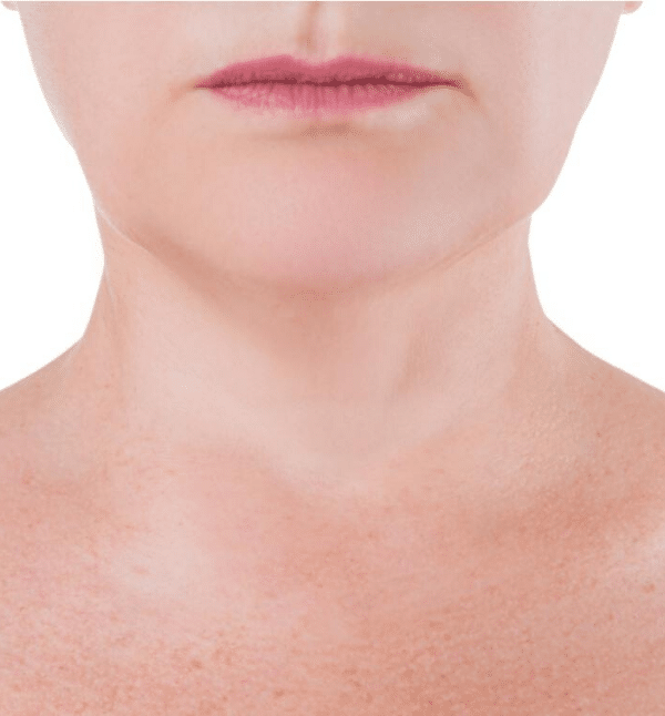 HIFU Skin Tightening — After