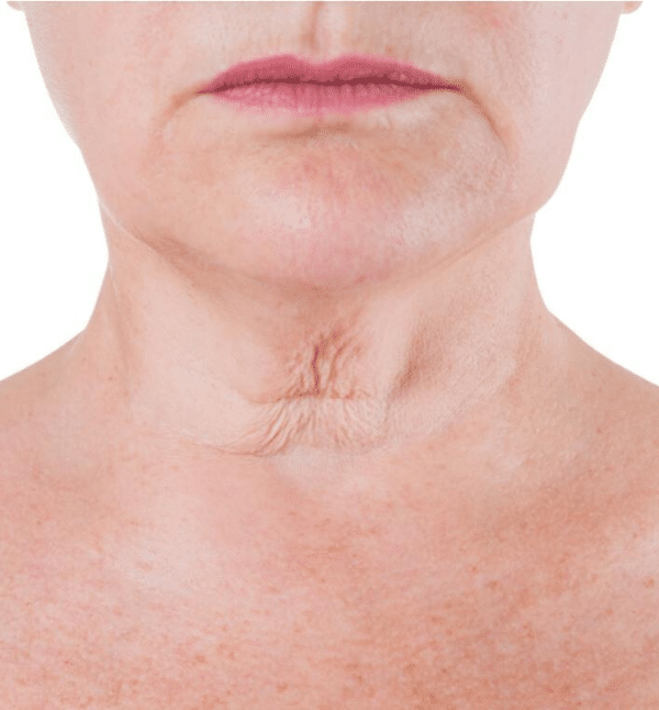 HIFU Skin Tightening — Before