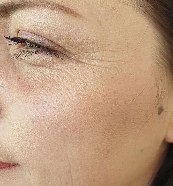 Fine Lines & Wrinkles — Before