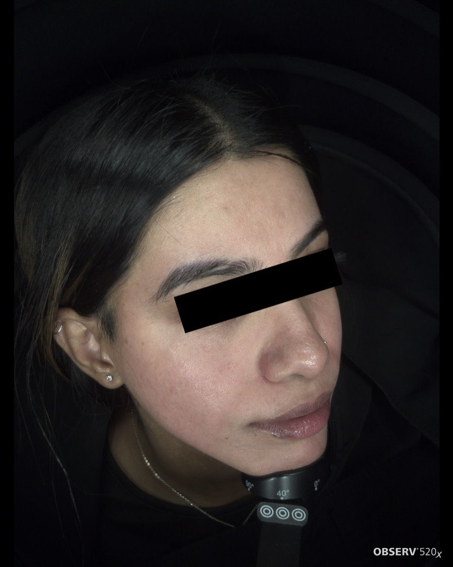 Acne & Pigmentation Treatment — After