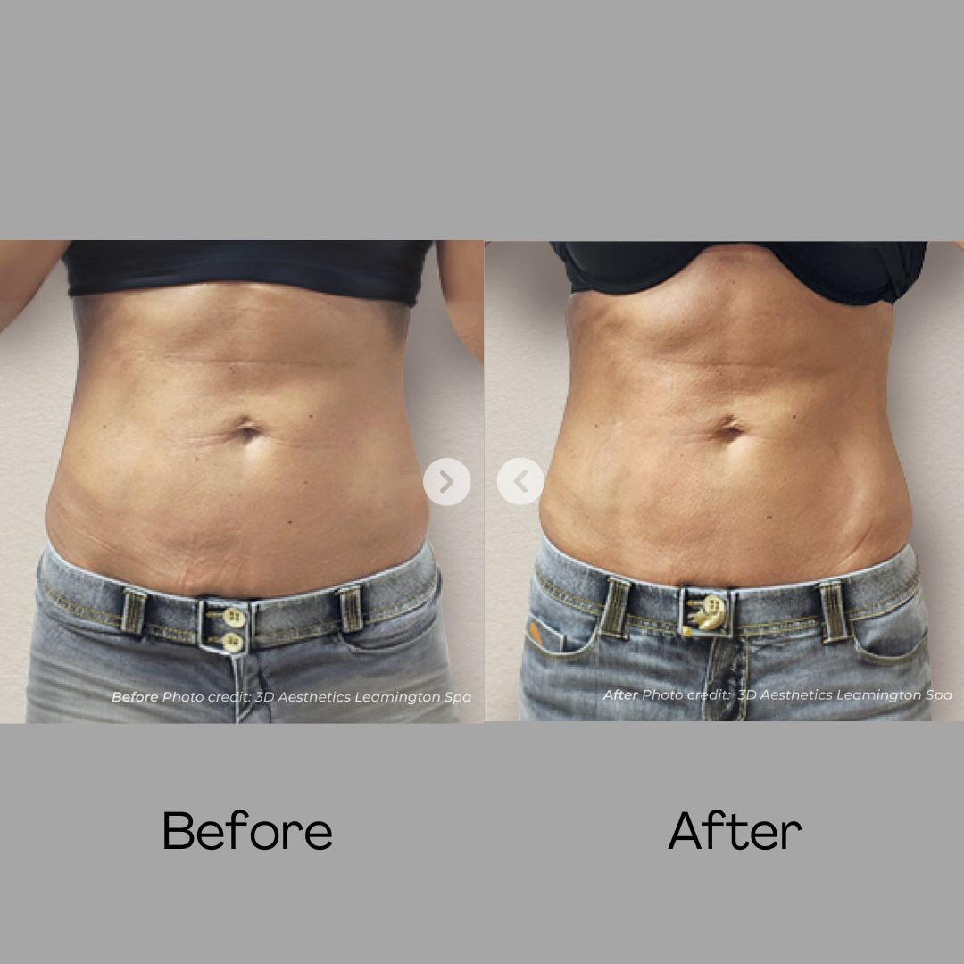 Muscle Toning before and after results