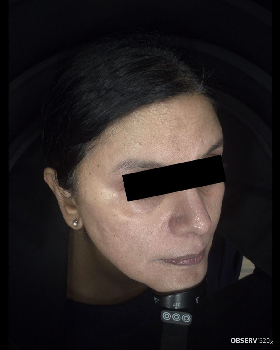 After Acne & Pigmentation Treatment treatment