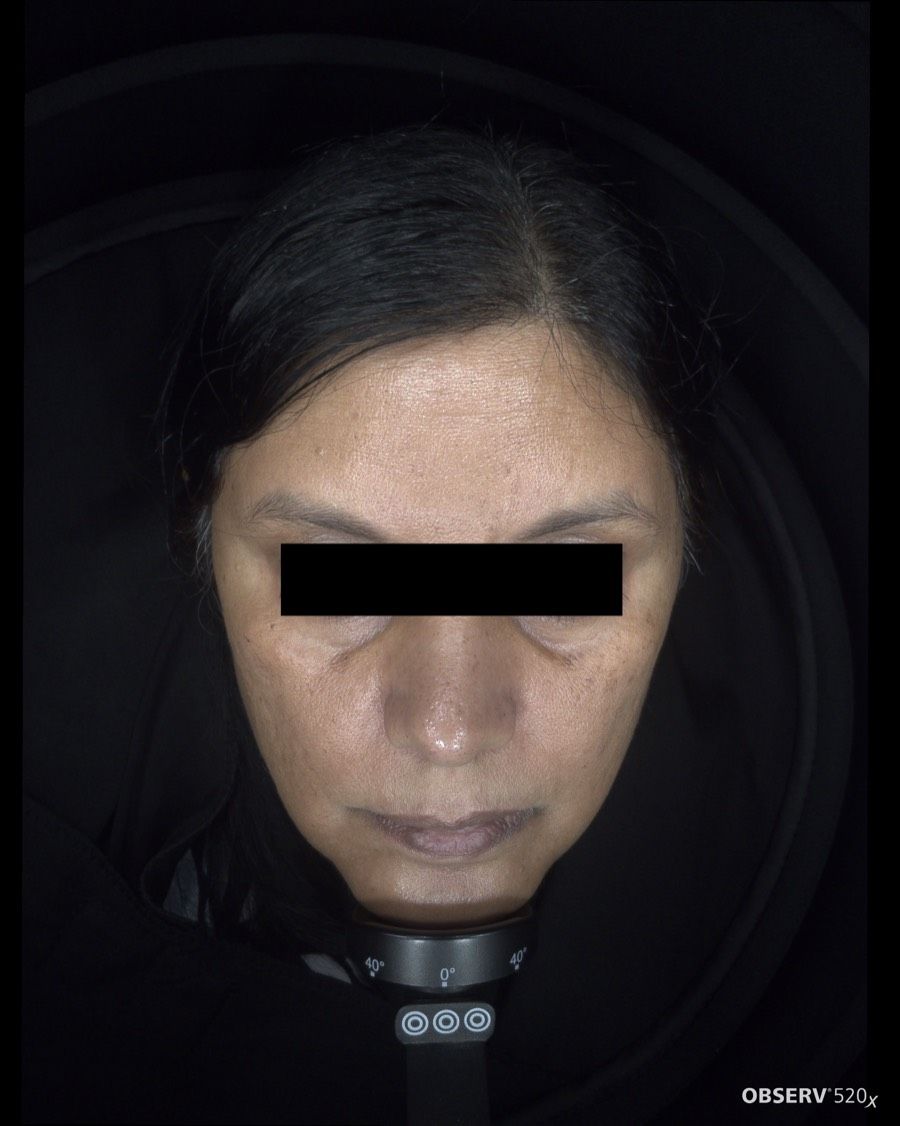 Before Acne & Pigmentation Treatment treatment