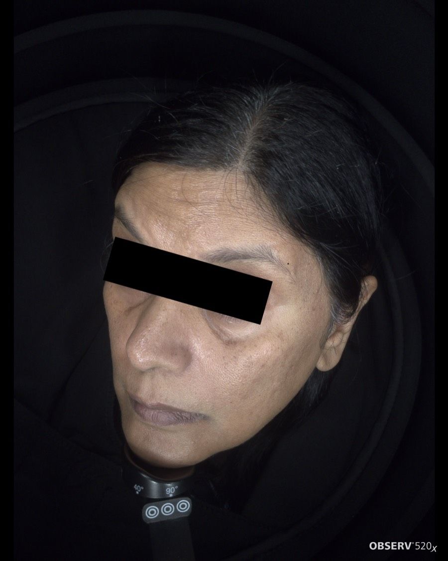 Before Acne & Pigmentation Treatment treatment