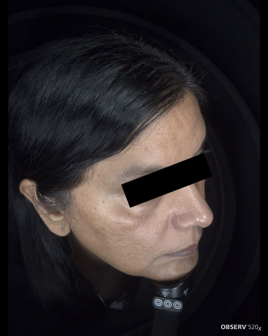 Before Acne & Pigmentation Treatment treatment